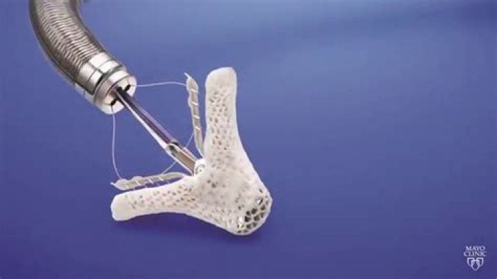 What is a mitral valve clip?